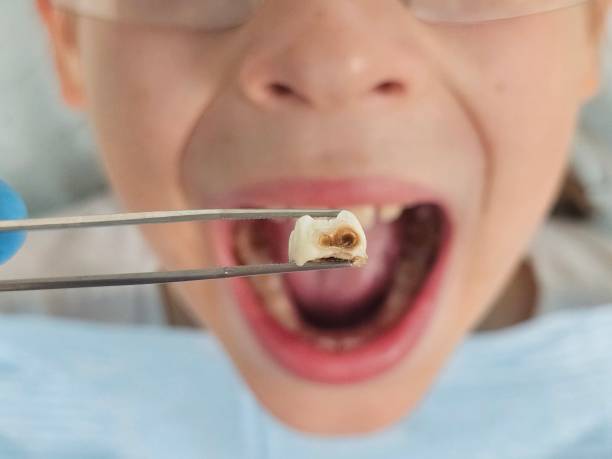 Best Root Canal Emergency Dentist  in Lake City, PA
